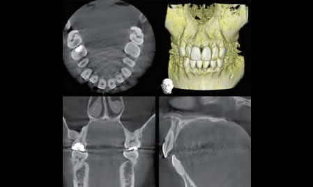 CT１